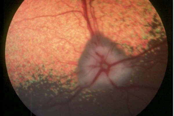 Generalised Progressive Retinal Atrophy (GPRA)